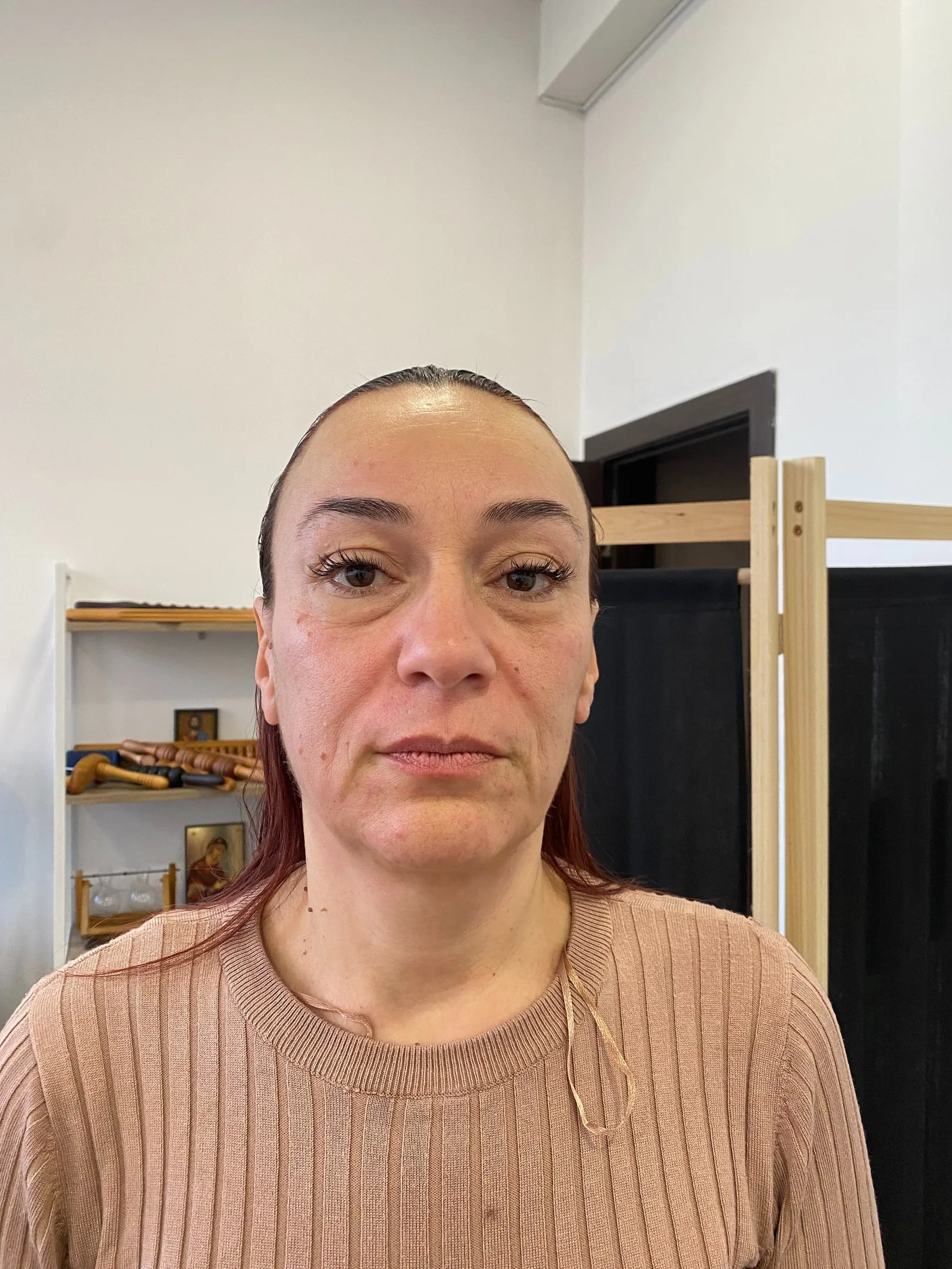 Същото лице след серия остеоестетични процедури — по-отворен поглед и по-ясен контур